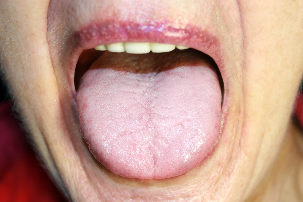pecas en la lengua
