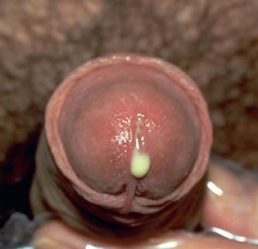 Gonorrhea Pictures - Picsearch