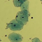 List of all STDs and their Symptoms