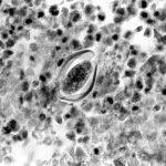 Pelvic Inflammatory Disease (PID)