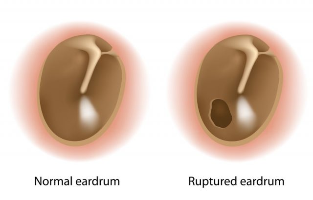 Ruptured Eardrum