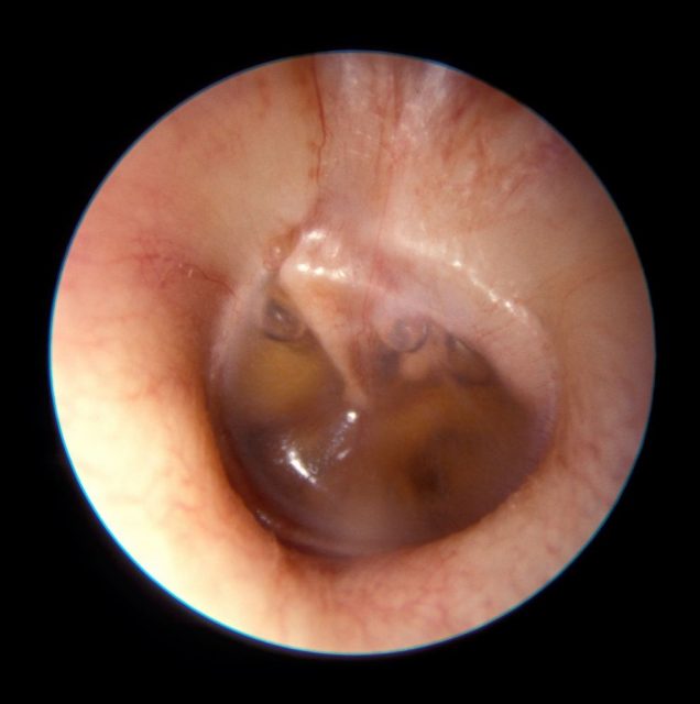 Malignant Otitis Media