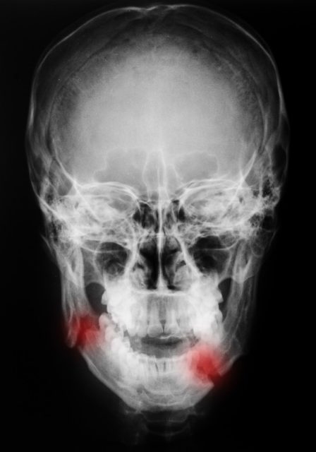 X-ray, skull, Fracture mandible