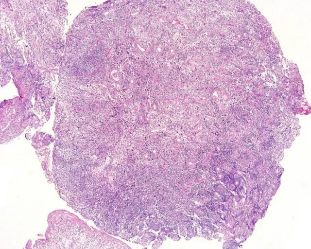 An intermediate magnification of a H&E stained biopsy from an otic polyp