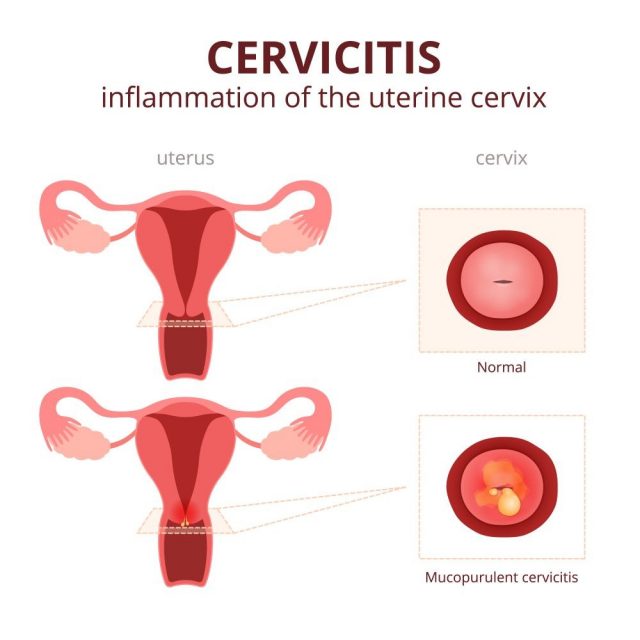 cervicitis, schematic illustration of the uterus and the cervix, female reproductive system diseases