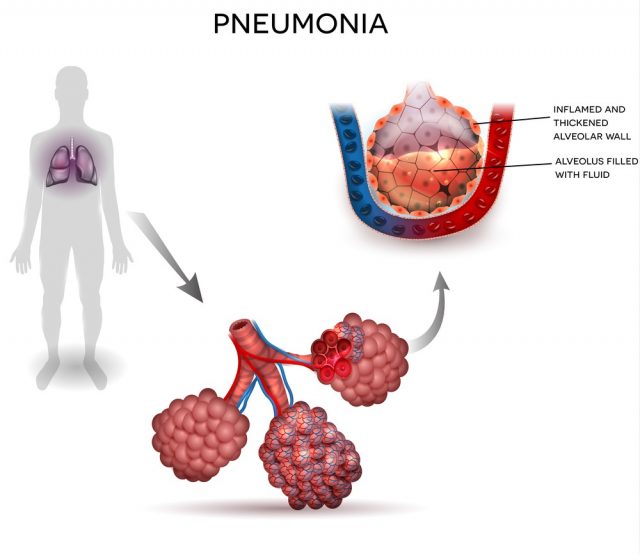 Pneumonia illustration, human silhouette with lungs, close up of alveoli and inflamed alveoli with fluid inside