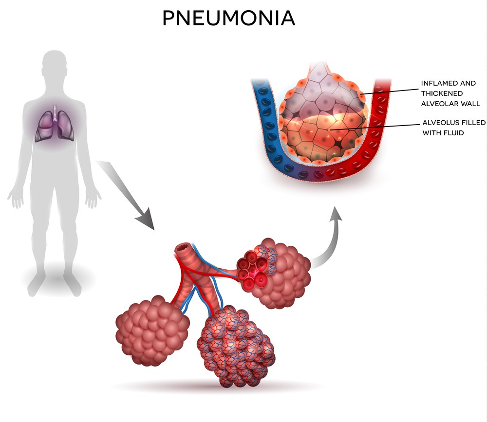 Chlamydia Pneumoniae - symptoms, types, diagnosis, treatment