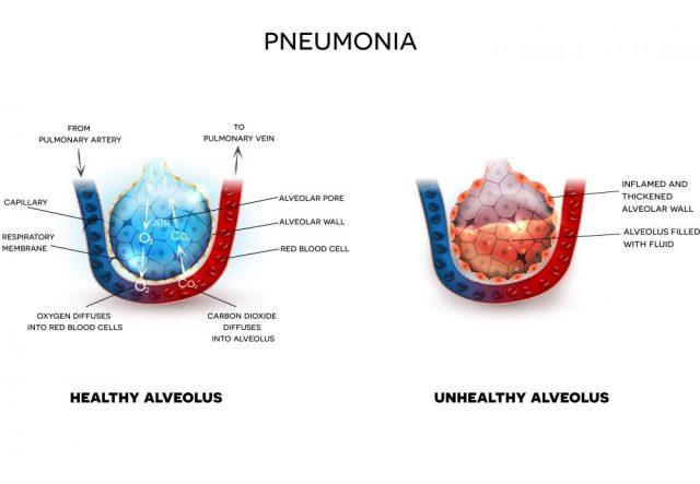 Pneumonia illustration, alveoli with fluid and healthy Alveoli, oxygen and carbon dioxide exchange between alveoli and capillaries