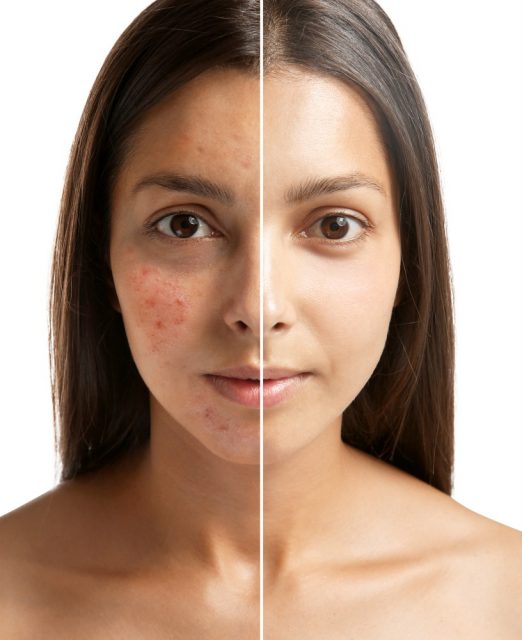 Woman face before and after acne treatment procedure