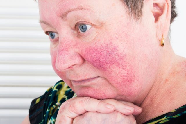 Woman with Rosacea