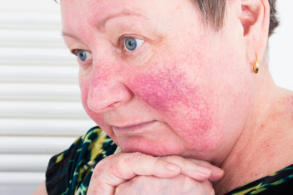 Rosacea is commonly observed... 