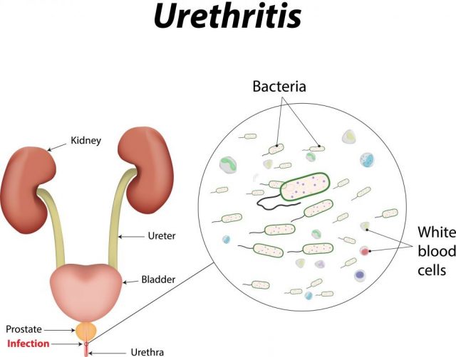 Bloody Discharge - Urethritis