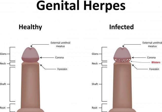 Bloody Discharge - Genital Herpes