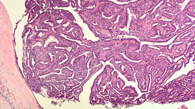 Bloody Discharge: Breast Biopsy - Microscopic image (photomicrograph) of an intraductal papilloma