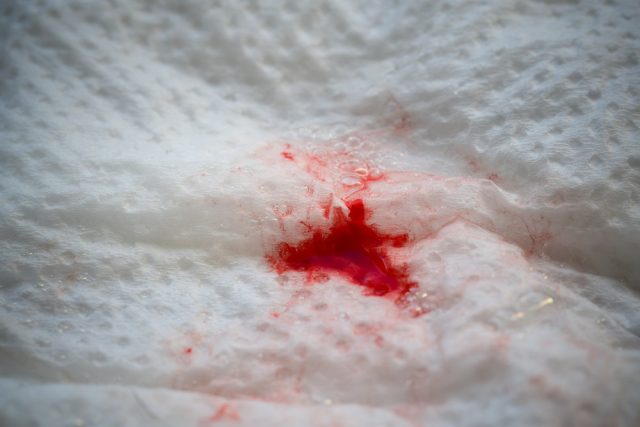 Bloody mucus on tissue paper - Discharge