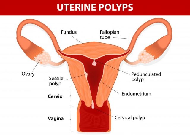 Endometrial polyp or uterine polyp - Bloody Discharge