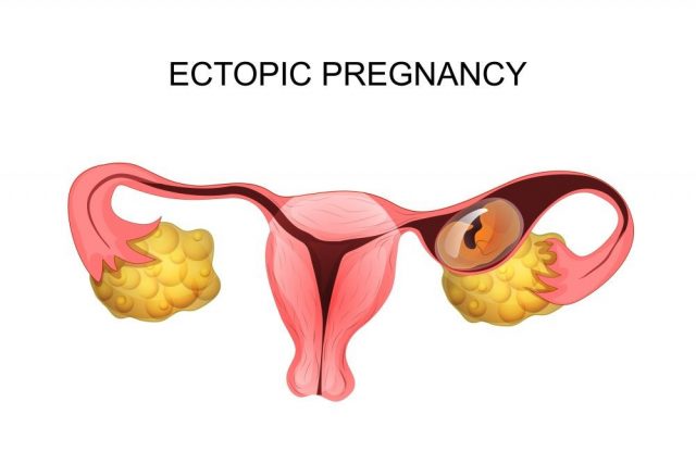 illustration of uterus with ectopic pregnancy