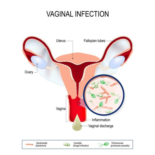 Causes of a Bad Vaginal Odor