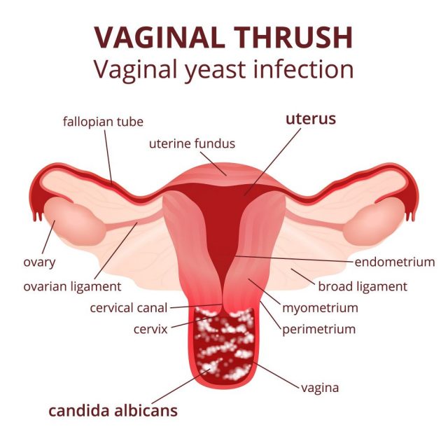 Causes of a Bad Vaginal Odor