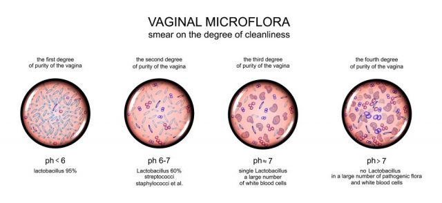 Causes of a Bad Vaginal Odor