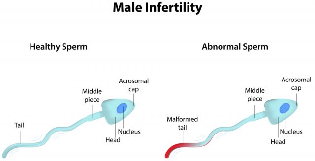 Male Infertility