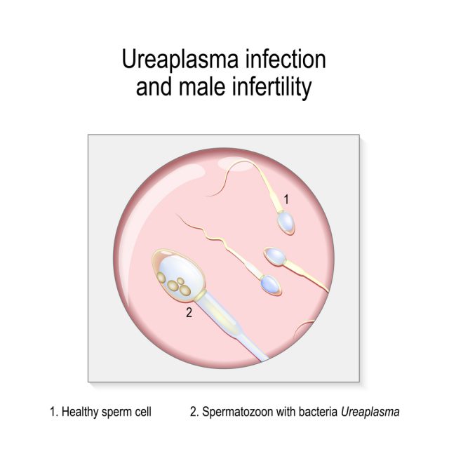 Male Infertility Ureaplasma