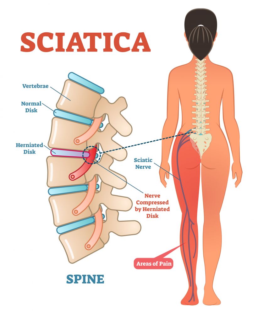Sciatic Nerve Pain (Sciatica): Symptoms, Causes, Exercises | STD.GOV Blog