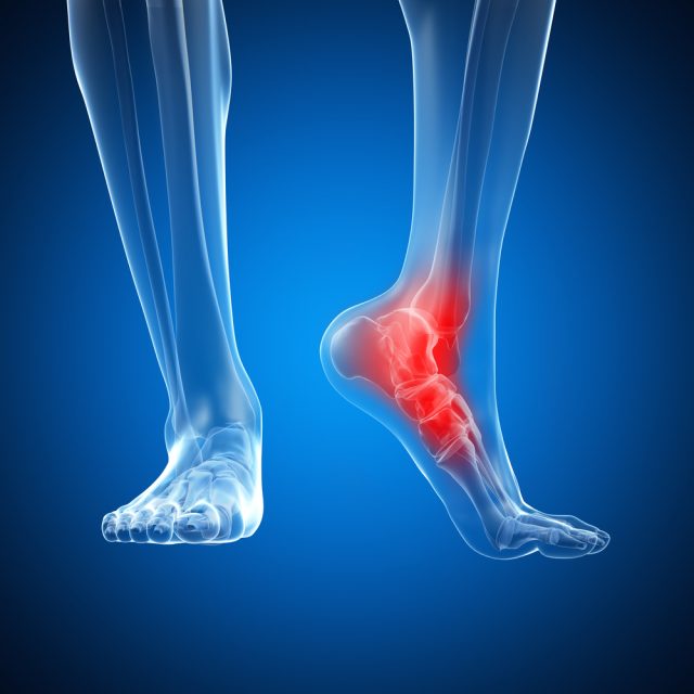 Ankle Pain