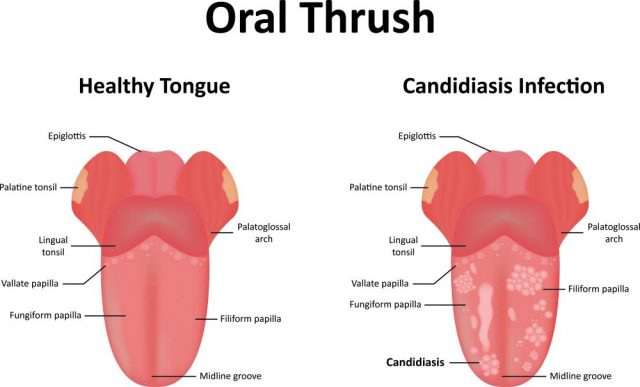 Why is my tongue yellow