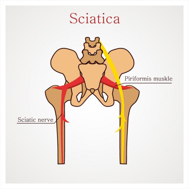 Sciatica