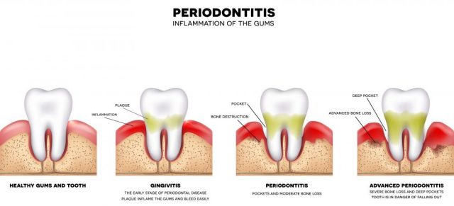 Gum infection