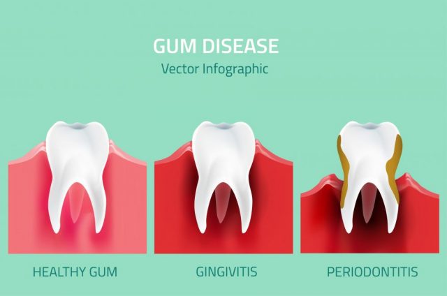 Gum infection