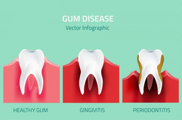 Gum infection