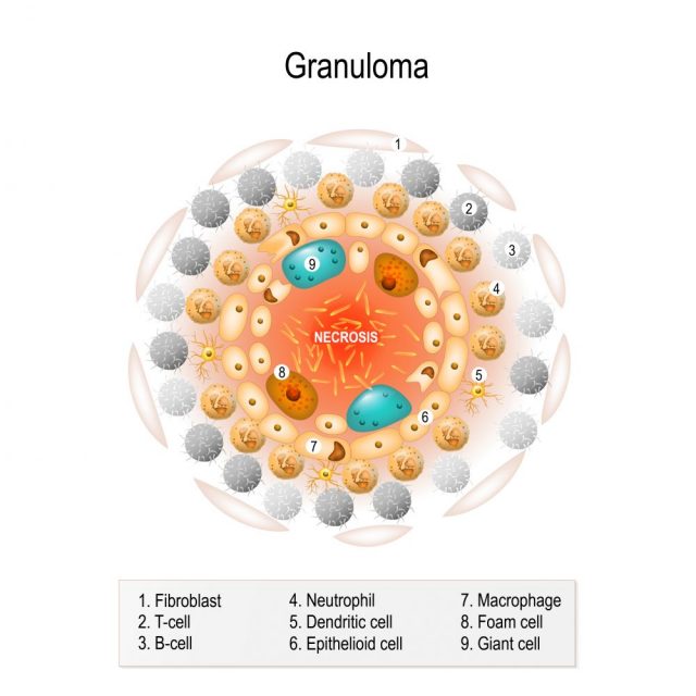 Immune System Diseases granuloma