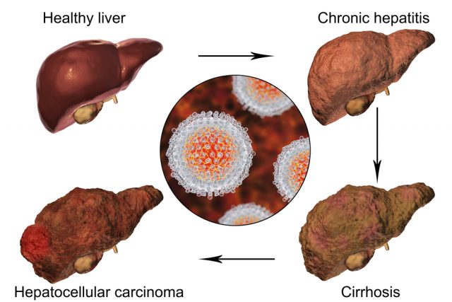 Hepatitis A