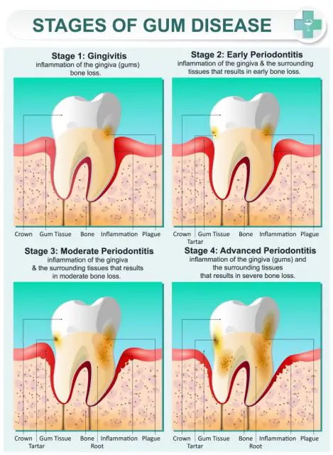 Gingivitis and Periodontitis