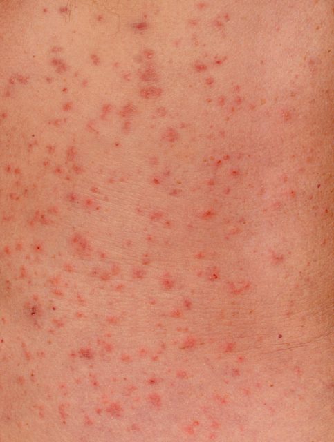 Eczema Around the Eyes