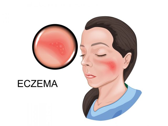 Eczema Around the Eyes