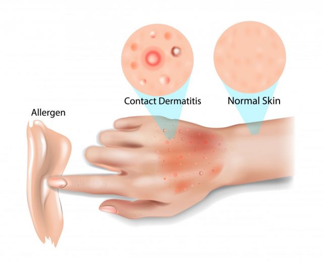 Eczema Around the Eyes