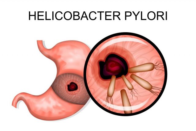 Helicobacter Pylori