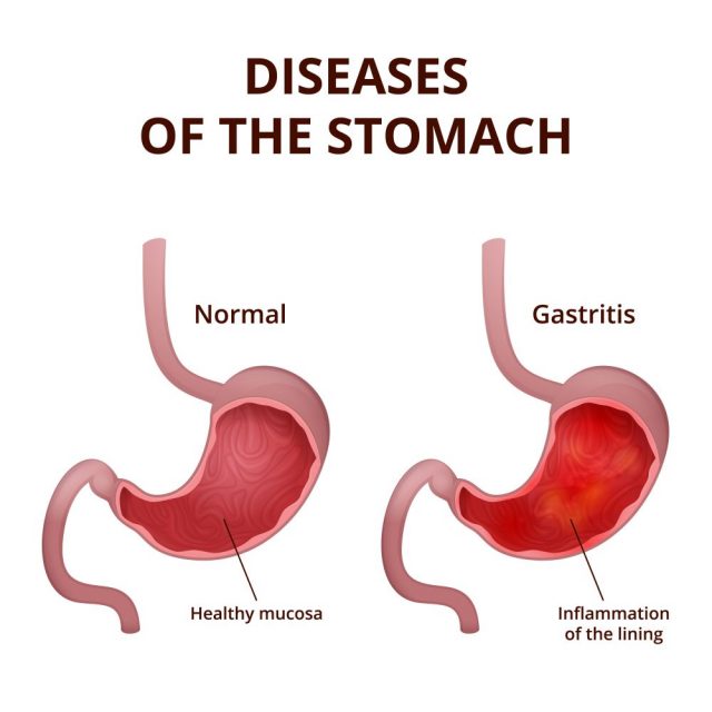 Stomach Polyps