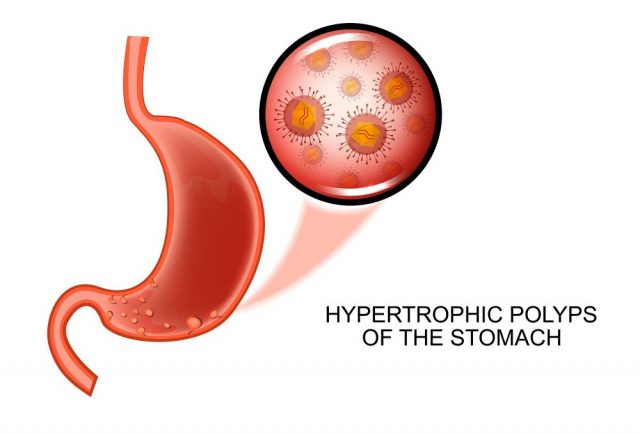 Stomach Polyps