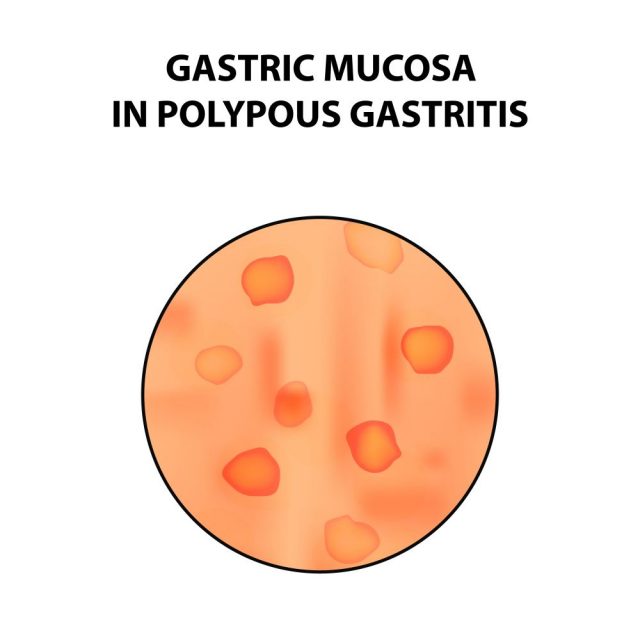 Stomach Polyps