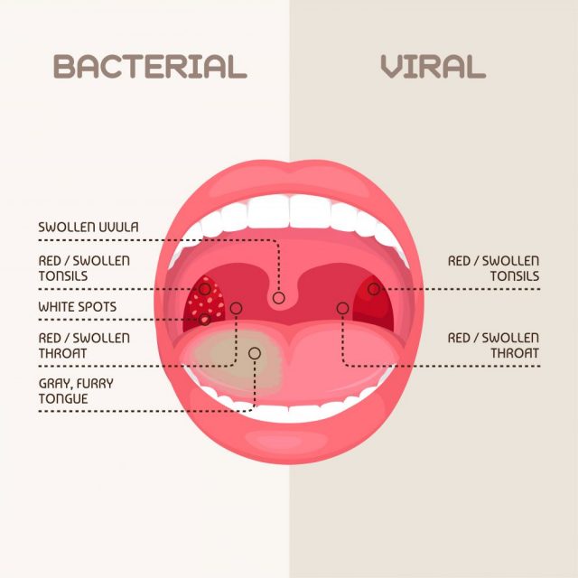 Chronic Pharyngitis