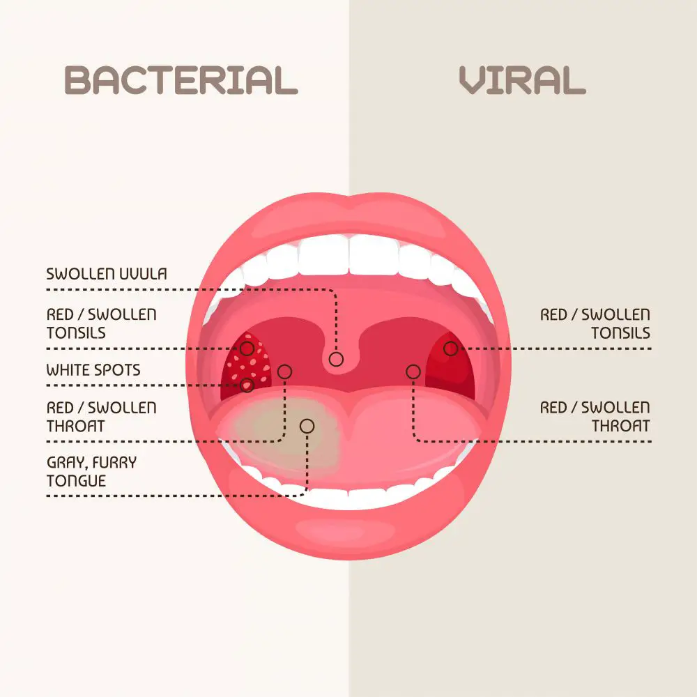 Faringitis Bacteriana