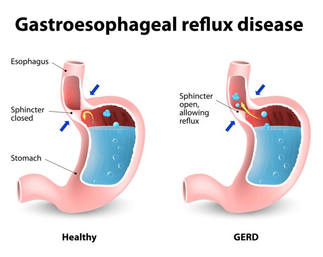 Chronic Pharyngitis