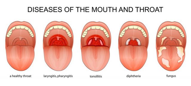 Chronic Pharyngitis