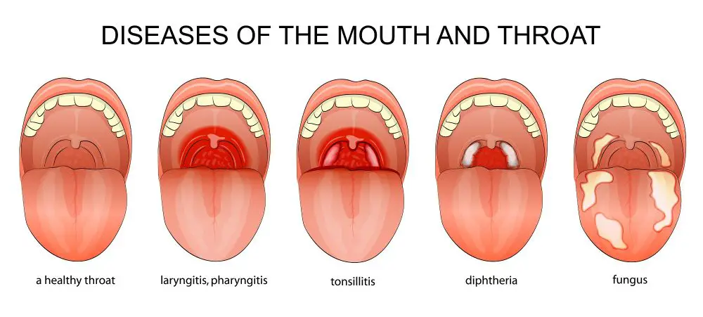 Chronic Pharyngitis Symptoms Causes Home Remedies Stdgov Blog