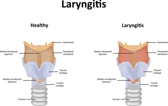 Chronic Pharyngitis