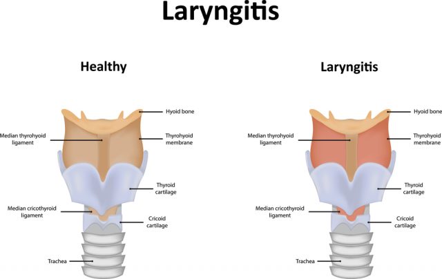 Chronic Pharyngitis